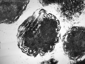 M,12y. | mast cell - granules with scroll-like formations - skin, urticaria pigmentosa